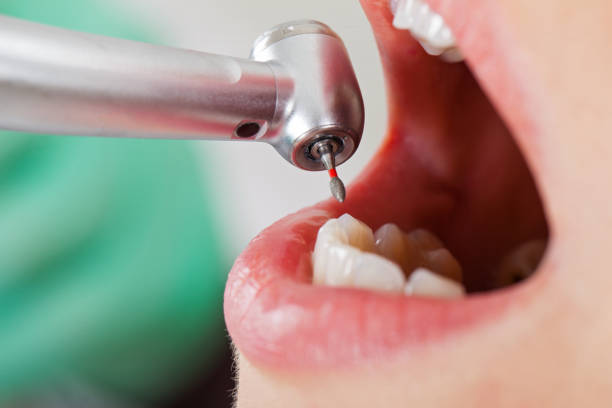Best Emergency Root Canal Treatment in Grill, PA